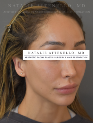 Hairline Lowering/Forehead Reduction Case 5179 Before Photo Hairline Lowering/Forehead Reduction