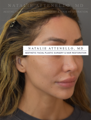 Hairline Lowering/Forehead Reduction Case 5179 After Photo Hairline Lowering/Forehead Reduction
