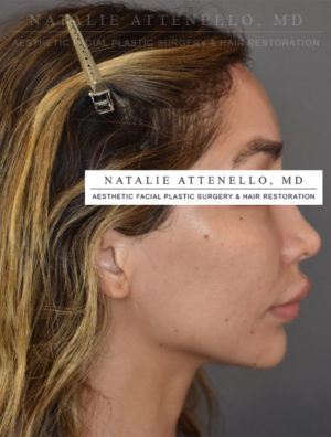 Hairline Lowering/Forehead Reduction Case 5179 After Photo Hairline Lowering/Forehead Reduction