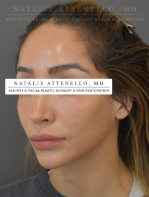 Hairline Lowering/Forehead Reduction Case 5179 Before Photo Hairline Lowering/Forehead Reduction