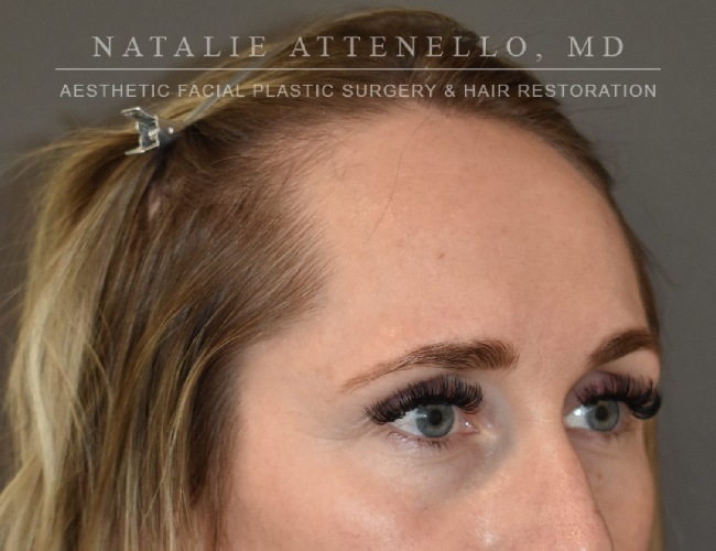 before hairline lowering treatment