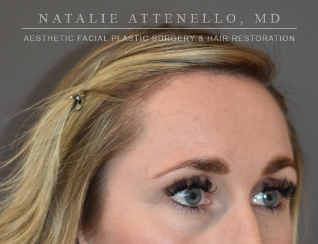 after hairline lowering treatment