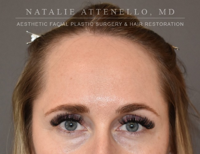 before hairline lowering treatment