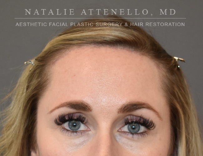 after hairline lowering treatment