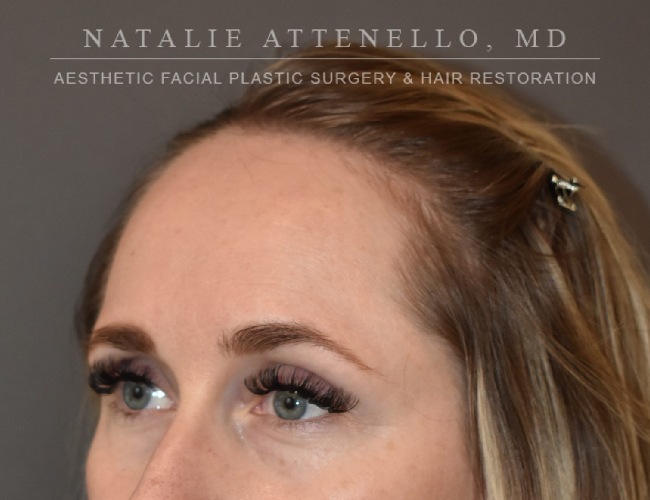 before hairline lowering treatment