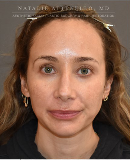 before hairline lowering treatment