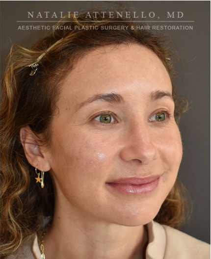 after hairline lowering treatment
