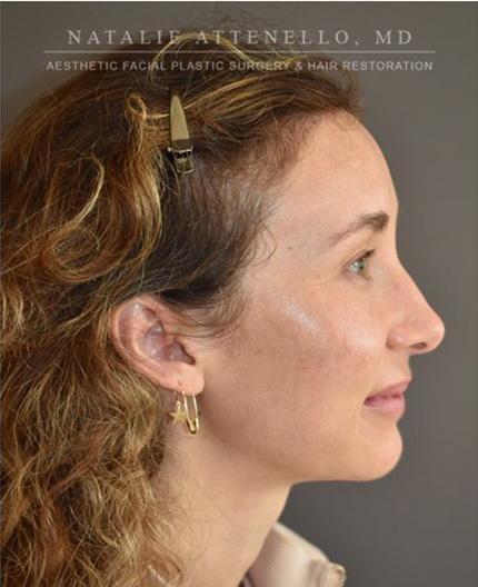 after hairline lowering treatment