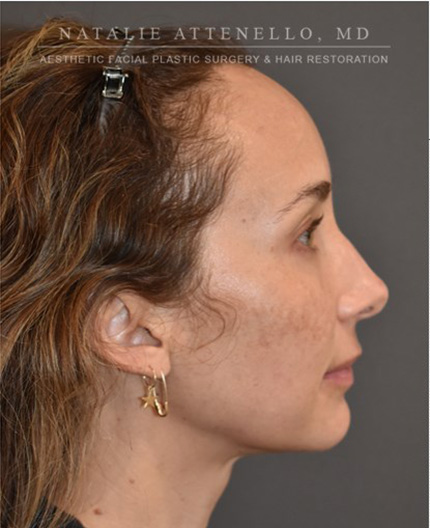 before hairline lowering treatment