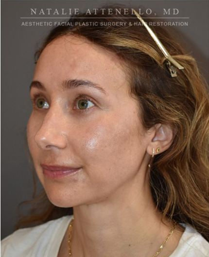 after hairline lowering treatment