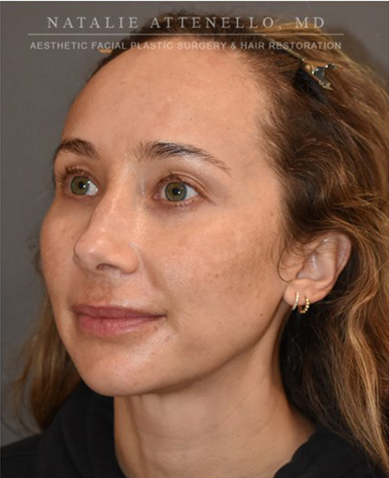 before hairline lowering treatment