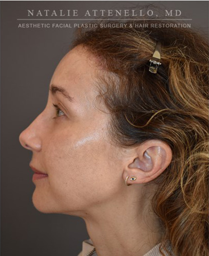 after hairline lowering treatment