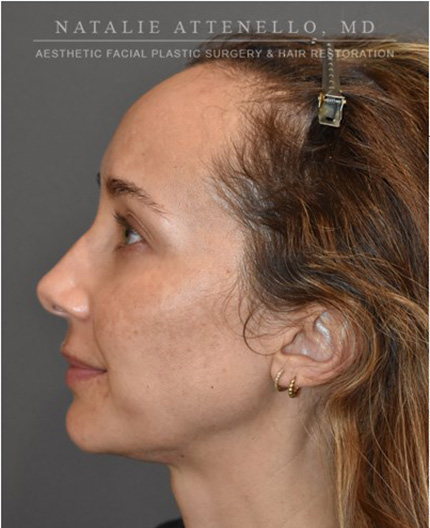 before hairline lowering treatment