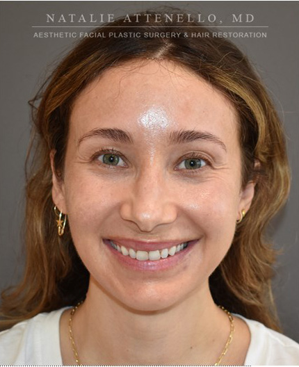 after hairline lowering treatment